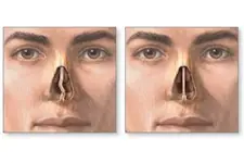 Burun Kıkırdağı Yamukluğu Belirtileri ve Tedavisi