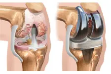 Diz Kıkırdak Zedelenmesi Belirtileri ve Tedavisi
