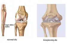 Diz Kıkırdak Zedelenmesi Bitkisel Tedavi