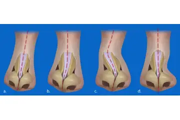 Burun Kıkırdak Eğriliği Ameliyatı Riskleri ve Sonrası