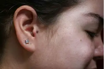 Kıkırdak Piercing İltihap Belirtileri ve Tedavisi