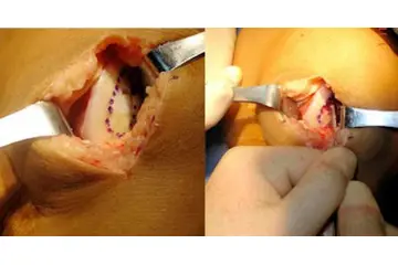 Kıkırdak Yenileyici Özellikleri ve Faydaları Nelerdir?