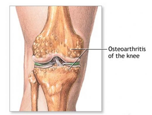 Kıkırdak Çeşitleri Nelerdir?