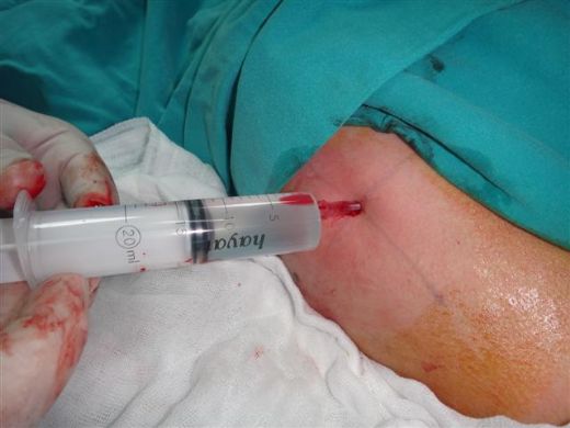 Kıkırdak İğnesi Nasıl Yapılır?